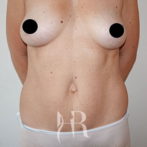 HR Plastic Surgery - Breast Enlargement patient before 9